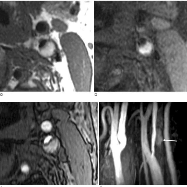 Fig. 2. Hemorrhagic plaque in a 64-year-old male with vascular dementia. The plaque signal intensity is bright on a T1-weighted image (a), T1-weighted image with fat-saturation (b), and source image of time-of-flight MR angiography (c)