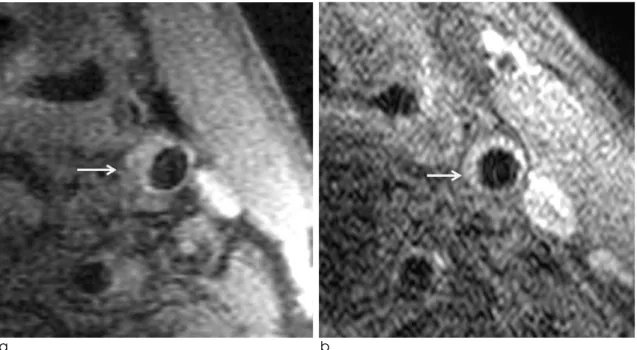 Fig. 4. Plaque regression after statin treatment in a 73-year-old male.