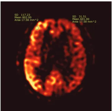 Fig. 2. An example of the ROI placement. ROIs were drawn in the both normal brain cortical areas and pathologic regions exhibiting the greatest CBF, and the values were recorded