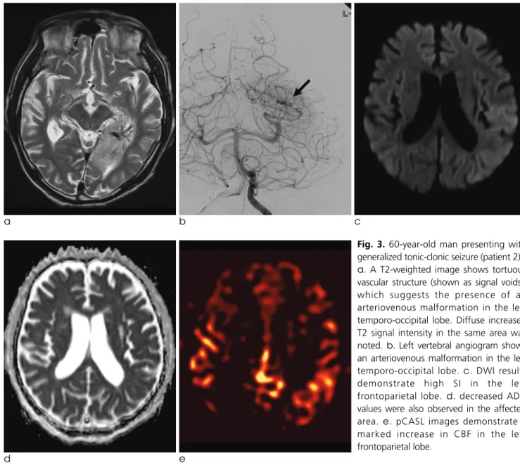 Fig. 3. 60-year-old man presenting with generalized tonic-clonic seizure (patient 2).