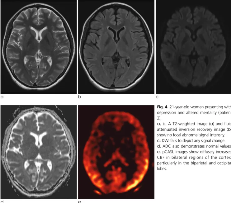 Fig. 4. 21-year-old woman presenting with depression and altered mentality (patient 3)
