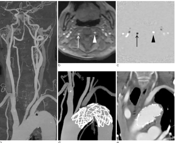 Fig. 3. A 76-year-old man (patient 1) with type B aortic dissection after bike accident