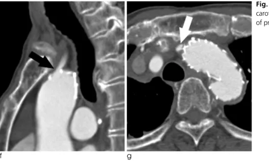 Fig. 3. f,  g. The origin of left common carotid artery (arrow) is intact just in front of proximal end of stent-graft