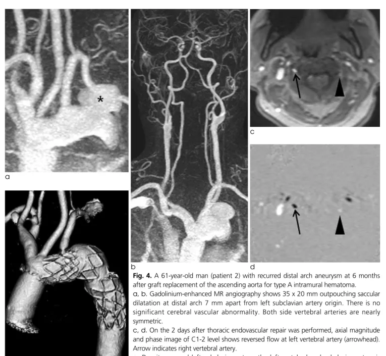 Fig. 4. A 61-year-old man (patient 2) with recurred distal arch aneurysm at 6 months after graft replacement of the ascending aorta for type A intramural hematoma