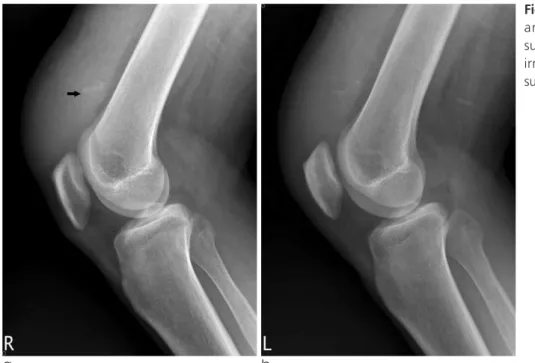 Fig. 1. Lateral radiographs of right (a) and left (b) knees demonstrate suprapatellar soft tissue swelling and irregular shaped calcifications in the suprapatellar soft tissue (arrow in a).