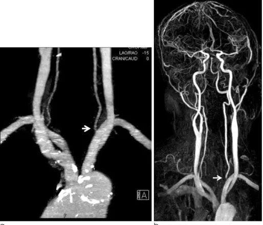 Fig. 2. a. CTA shows no stenosis of the origin of the left vertebral artery.