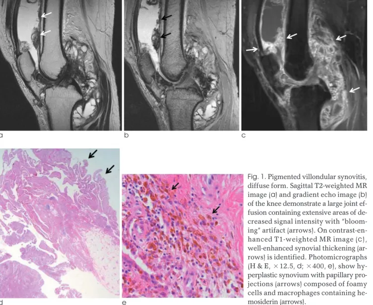 Fig. 1. Pigmented villondular synovitis, diffuse form. Sagittal T2-weighted MR image (a) and gradient echo image (b) of the knee demonstrate a large joint  ef-fusion containing extensive areas of  de-creased signal intensity with  “bloom-ing” artifact (arr