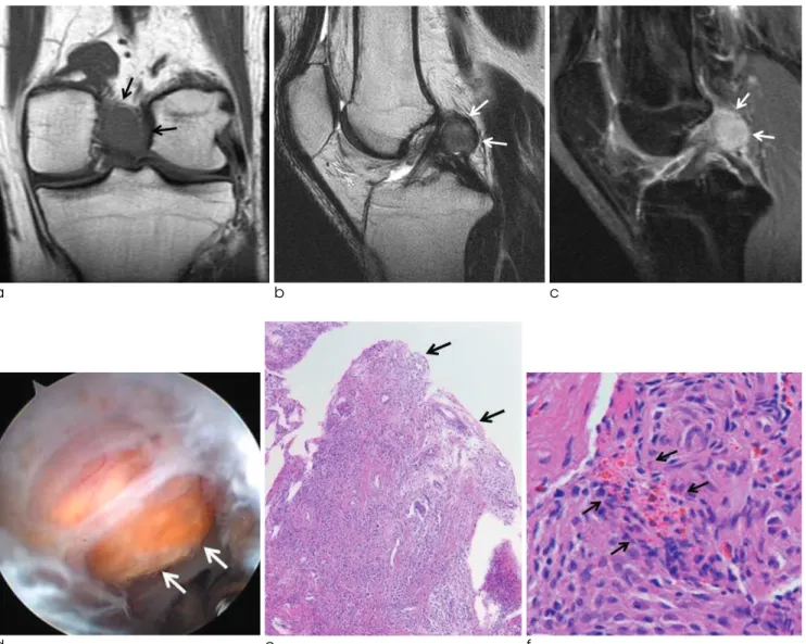 Fig. 2. Pigmented villonodular synovitis, localized form. Coronal T1-weighted MR image (a), sagittal T2-weighted MR image (b) and sagittal contrast enhanced fat-suppressed T1-weighted MR image (c) demonstrate a focal round lesion (arrows) at the intercondy