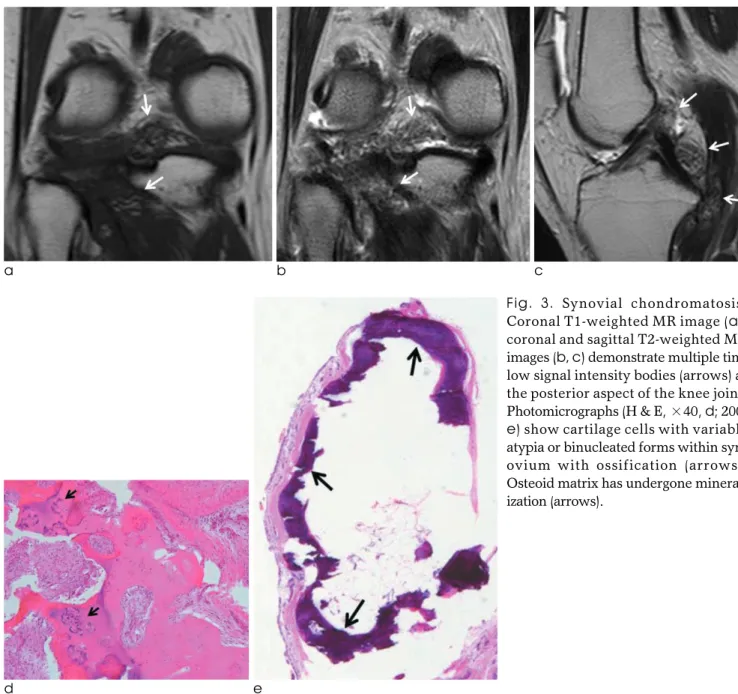 Fig.  3. Synovial chondromatosis.