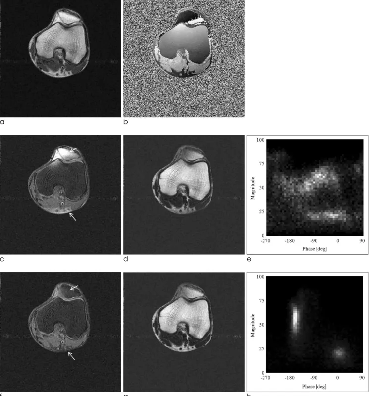 Fig. 7. In-vivo axial knee images of a volunteer. Magnitude of the in-phase image (a), phase of the out-of-phase image (b) ob- ob-tained by a spin echo sequence at 0.35 T(TR=500 ms, TE=25 ms, FOV=230 mm, spatial resolution= 0.89 mm, flip angle (FA)=90�, sl