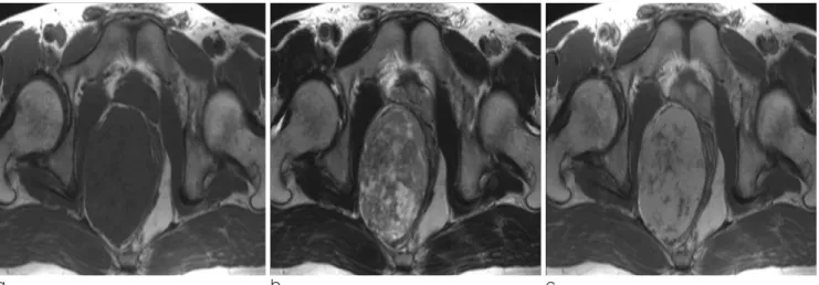 Fig.  1.  Contrast enhanced coronal reformatted CT shows large, well defined mass with heterogeneous attenuation in the right ischiorectal fossa.