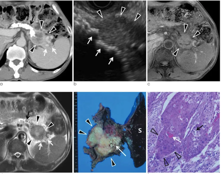 Fig.  1.  (a) Contrast enhanced CT scan shows heterogeneously peripheral enhancing solid mass (arrowheads) and perilesional invasion (white arrows) on equilibrium phase