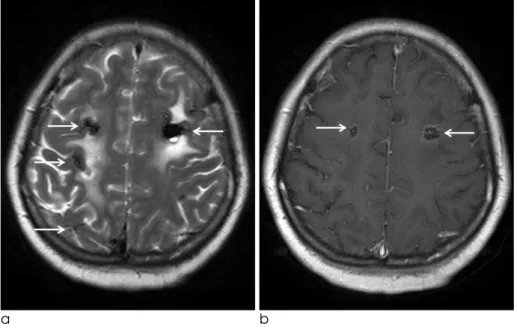 Fig. 3. Follow up MRI was per- per-formed 3-weeks after whole-brain radiotherapy.