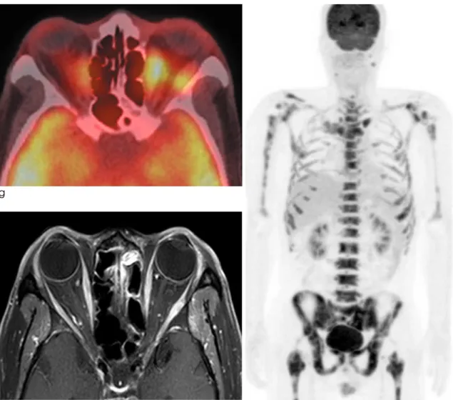 Fig. 1. (g-h) 18 F-FDG PET/CT performed on the same day with the 2nd follow-up orbit MRI