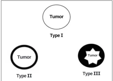 Fig. 1. Diagrams of the enhancement patterns on the con- con-trast-enhanced MRI performed immediately after RFA: