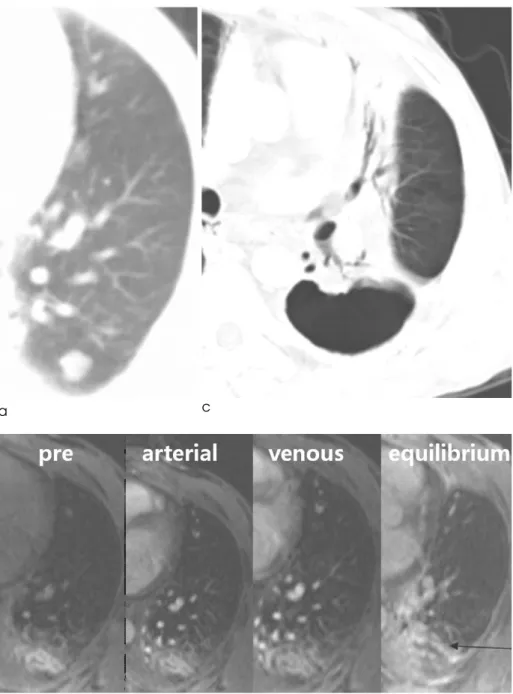 Fig. 2. 46-year-old man with a com- com-plete response. He had undergone radiation therapy due to lung  malig-nancy