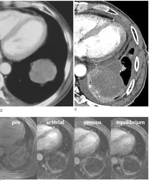 Fig. 3. 62-year-old man with progres- progres-sive disease. (a) Contrast-enhance chest CT scans before RFA shows a 6 cm mass in the left lower lobe