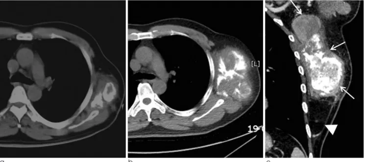 Fig.  1.  Lipoma-like liposarcoma with osteosarcomatous dedifferentiation of the chest wall in a 58-year-old man