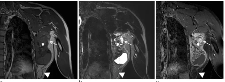 Fig. 2. Lipoma-like liposarcoma with osteosarcomatous dedifferentiation of the chest wall in a 58-year-old man