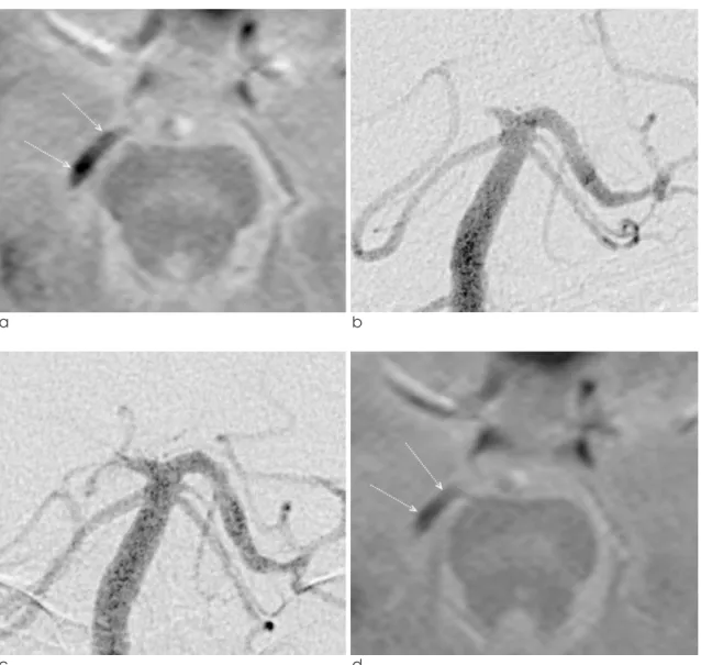 Fig. 1. A 52-year-old man presented with sudden vision loss and vertigo. (a) Baseline T2*-weighted gradient-echo imaging (T2*-GRE)