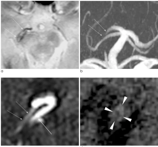 Fig. 2. One-week follow-up MR imaging. (a) T2*-GRE showed a newly developed hyperintensity within the susceptibility vessel sign (arrows; SAI, 1.60; diameter, 5.24 mm)