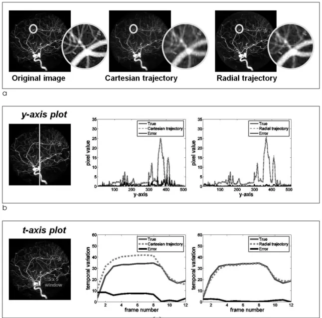 Fig.  6. k-t FOCUSS with KLT was implemented in Cartesian and radial trajectories at 12-fold acceleration and both resultant images are compared in (a)