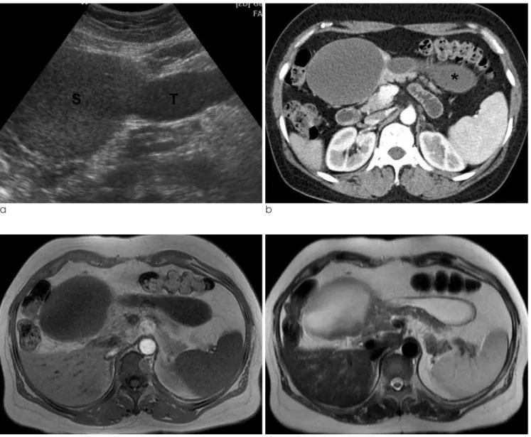 Fig. 1. (a) Ultrasound image shows a spherical (S) and tubular (T) cystic mass, containing relatively echogenic materials in spherical cyst of pancreatic head