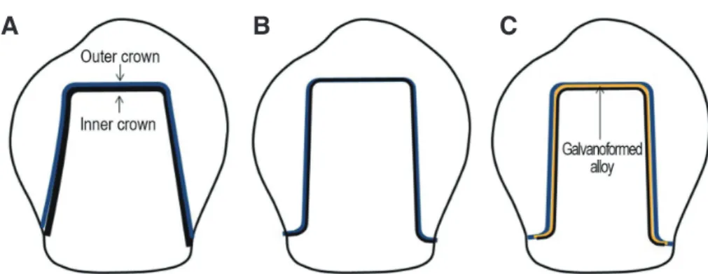 Fig. 1.  Schematic diagrams of a rigid type double crown system. (A) Conical double crown with wedging effect, (B)  Telescopic double crown with friction fit, (C) Galvanoformed (electroformed) double crown.