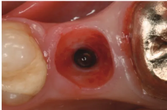 Fig. 5.  Zirconia abutment corresponding to the dimension  of the healing abutments avoiding any compression of  the peri-implant soft tissue.