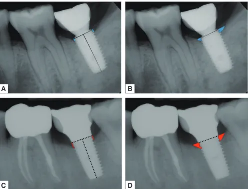 Fig. 3. Schematic of parameters performed in the radiographic analysis. Distance from implant shoulder to first bone-to- bone-to-implant contact (DIB, blue lines) (A) and peri-bone-to-implant area (PA, blue areas) (B) of the test group (internal connection