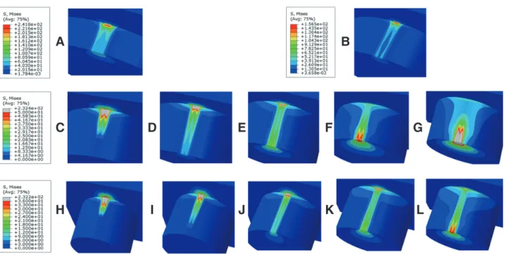 Fig. 1.  Sectional views of von Mises stress of the finite element model simulating the shear bond test