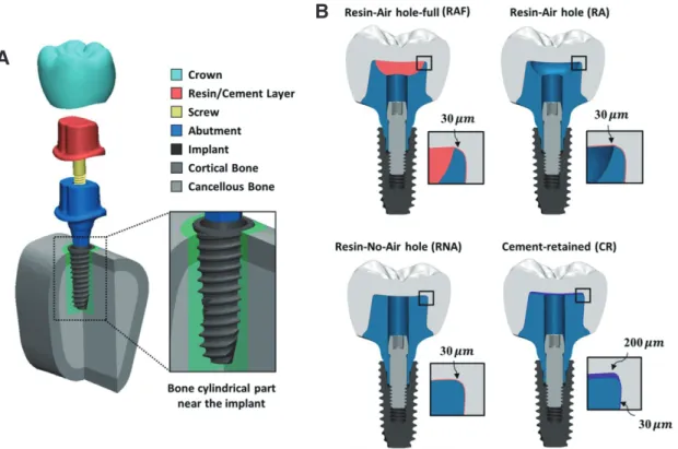Fig. 1 shows FE models and the structure of the implant  complex of three cases that used CLF implant prostheses  and one case that used a cement-retained (CR) implant
