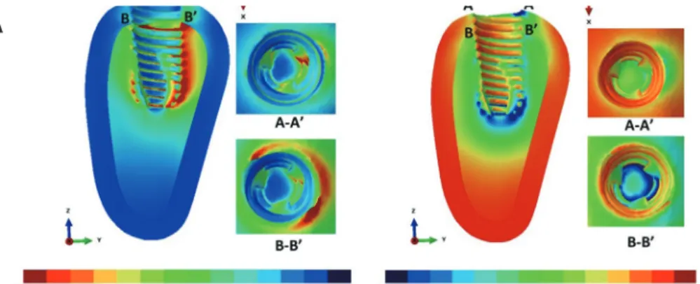 Fig. 6.  The principal strain distribution of the bone. The surrounding bone consists of cortical and cancellous bone