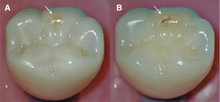 Fig. 4.  Wear facets visible on the disto-buccal cusp of  tested crowns after CS (arrows) using an endodontic  microscope at 12×; (A) MZr, (B) MLD.