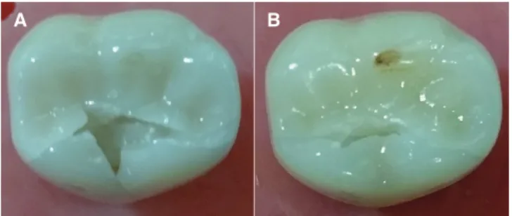 Fig. 7.  Representative SEM images after fracture  resistance testing showing hackles in both (A) MZr and  (B) MLD.
