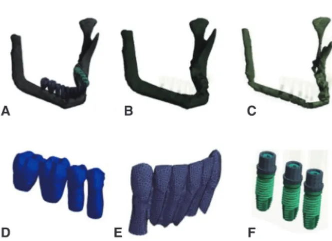 Fig. 1.  Three-dimensional finite element model. (A)  Reconstructed mandible, (B) Cortical bone, (C)  Cancellous bone, (D) Posterior implant prosthesis, (E)  Anterior implant prosthesis, (F) Implant fixture, gold  screw, and abutment.