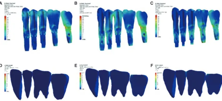 Fig. 5.  Stress distributions in implants and teeth. (A) FB1, (B) FB2, (C) FB3, (D) MN1, (E) MN2, (F) MN3.