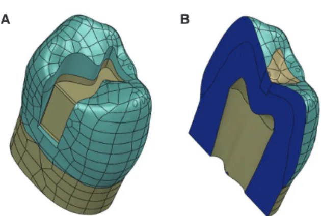 Fig. 1.  (A) MO cavity was created on the 3-D CAD mod- mod-el of the maxillary premolar tooth