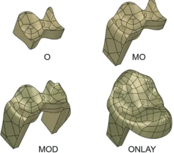 Fig. 2.  Models of 3 inlays and 1 onlay bodies restored on  the maxillary second premolars