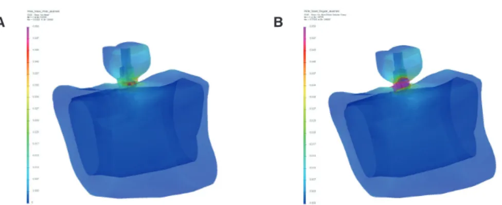 Fig. 2.  Overall stress distributions in the models. Stress concentrations were mainly observed at the bottom of the abutment  and on the top surface of the implant in both models