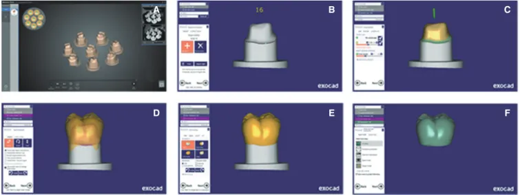 Fig. 2.  Interim crown design. (A) Multi die scan, (B) Margin set-up, (C) Cement space set-up, (D) Tooth placement, (E)  Margin modification, (F) Merge and save restoration.