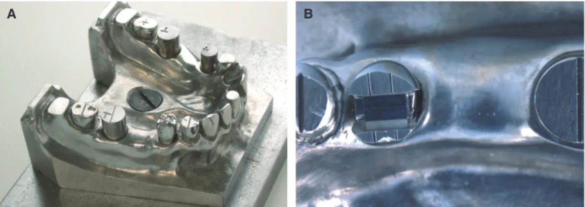 Fig. 1.  (A) Machined mandibular complete-arch metal model with special modifications before replacement of the right  second premolar, (B) Second premolar with modified overlay preparation with reference lines on the occlusal plane.