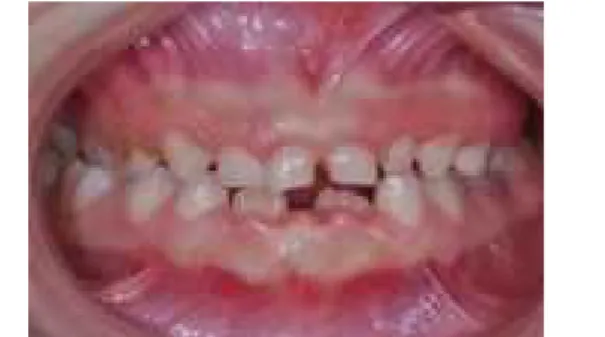 Fig. 4. Posterior cross bite at the right molar area is seen. 위험이 커질 수 있다 .  본 증례의 환아 역시 안과에서 마판  증후군과 관련된 수정체 전위를 진단받고 정기 검진 중이었 다 