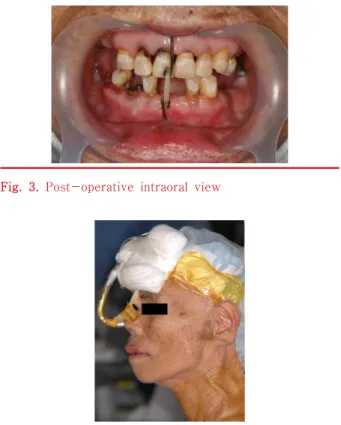 Fig.  4.  Post-operative  facial  viewFig.  1.  Initial  view  of  face  (A:  frontal,  B:  lateral) 