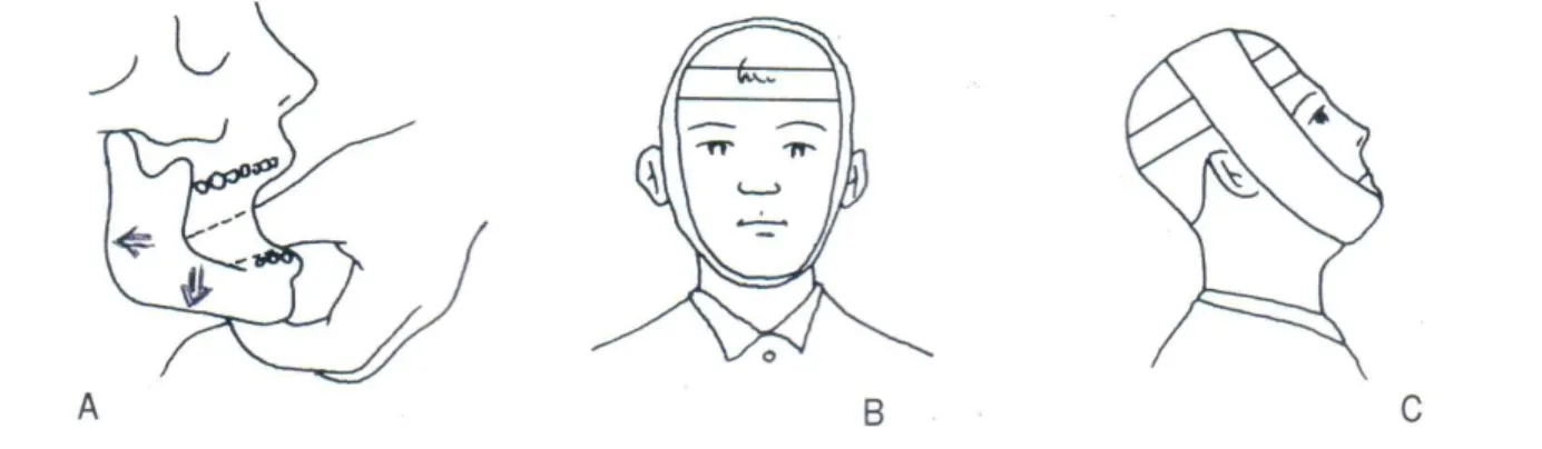 Fig.  9.  Manual  reduction  method  (A)  and  fixation  by  Barton's  bandage  (B,  C)