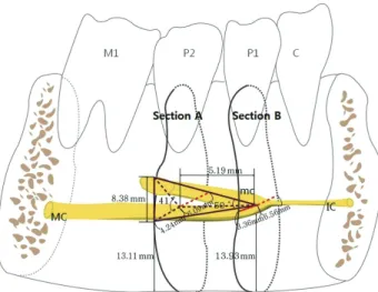 Fig. 3.  Schematic drawing shows the major course of the  mandibular canal which forms a hazardous tetrahedron  space at the interforaminal region
