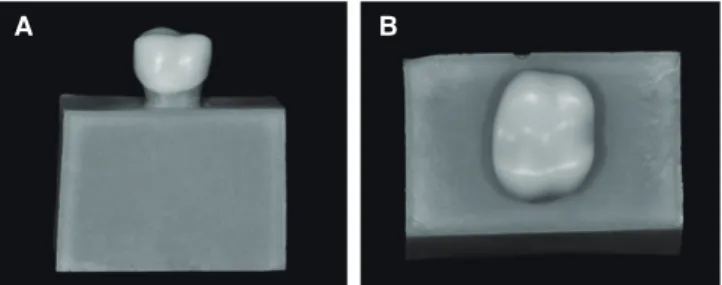 Fig. 2.  Monolithic zirconia crown, cemented on the  metal die with resin socket. (A) Vestibular view