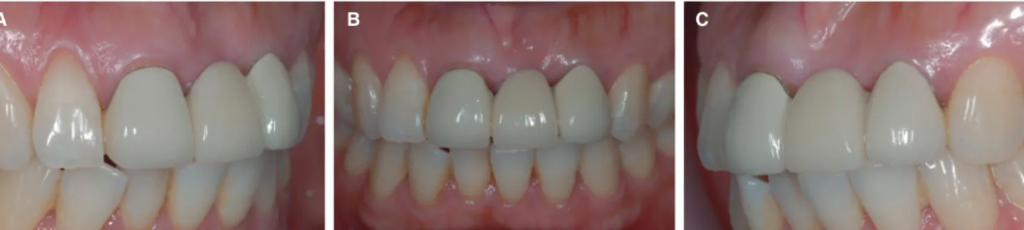 Fig. 1.  Pretreatment views of 3-unit fixed partial denture at the time of initial examination