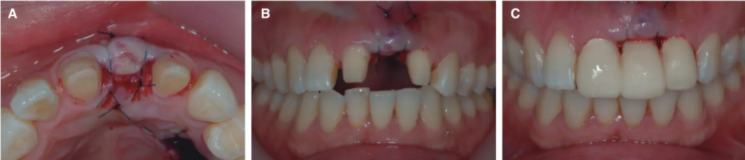 Fig. 5.  Sutures and immediate placement of provisional restoration. (A) Occlusal view and (B) labial view showed both  apical single-knot sutures to stabilize the transplant