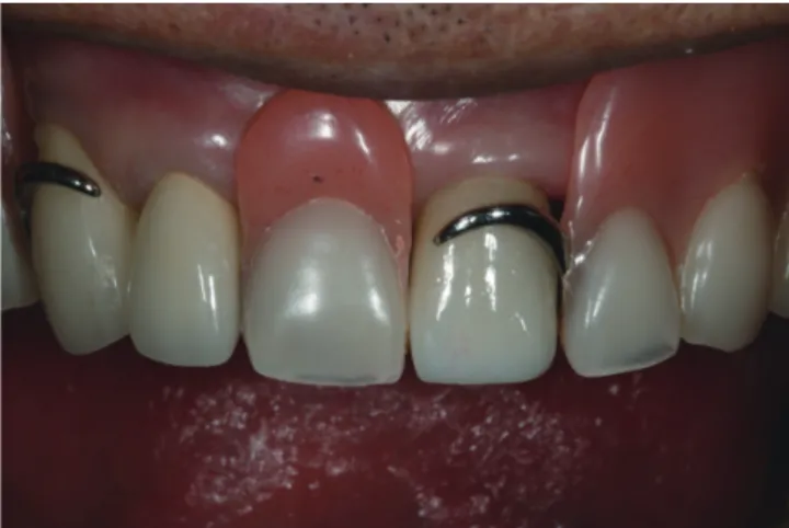 Fig. 6.  Comparing the contours of the previous crown  and resin pattern with the newly fabricated zirconia  crown.